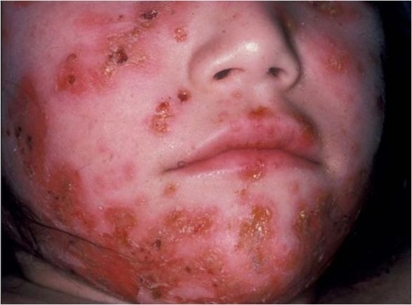 Impetigo is known as "school sores" in NZ